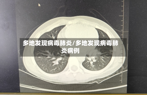 多地发现病毒肺炎/多地发现病毒肺炎病例