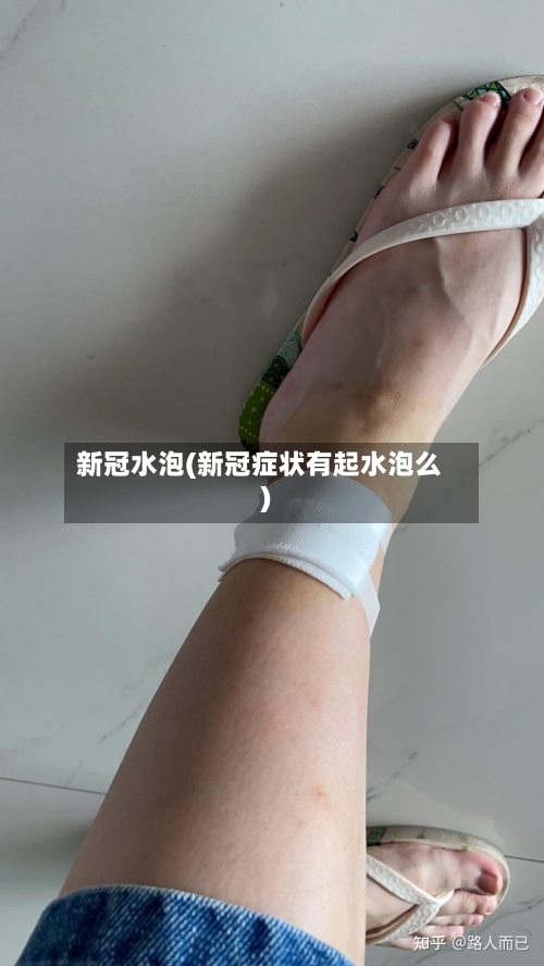 新冠水泡(新冠症状有起水泡么)-第3张图片